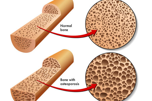 Osteoporosis